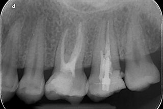 Il Ritrattamento Endodontico