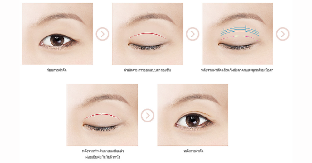 รีวิวศัลยกรรมชั้นตาไม่เท่ากัน
