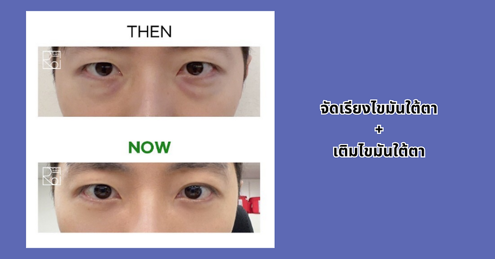 รีวิวฉีดไขมัน