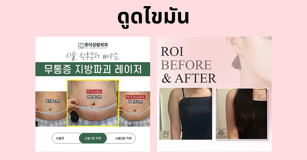 รีวิวศัลยกรรม