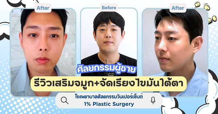 รีวิวเสริมจมูก+จัดเรียงไขมันใต้ตา