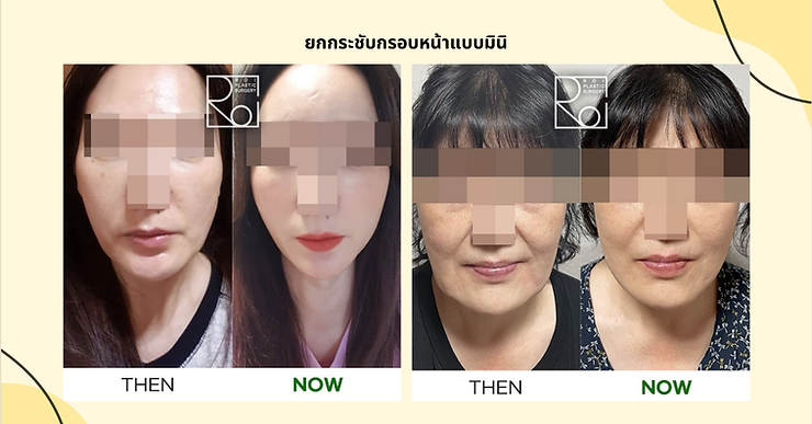 ศัลยกรรมยกกระชับหน้า