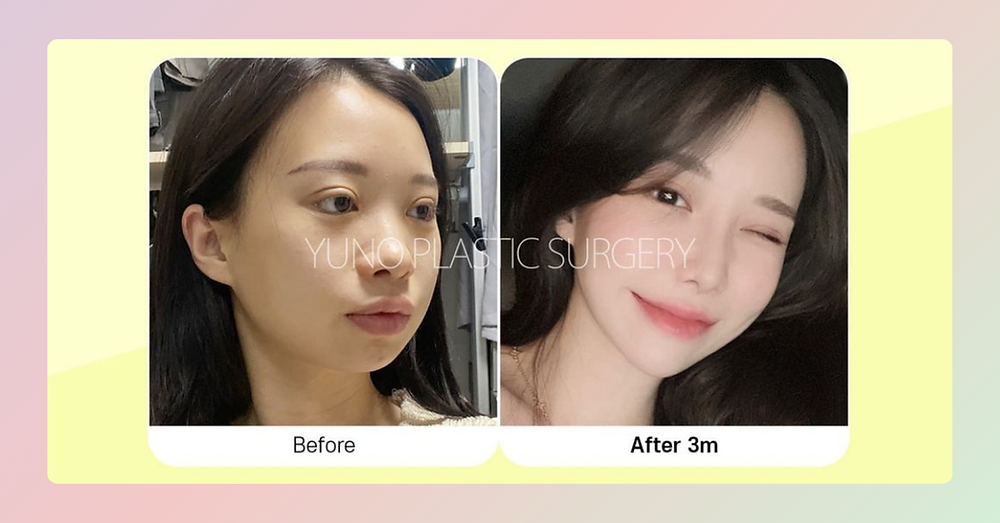 รีวิวผ่าตัดกราม ลดโหนกแก้ม