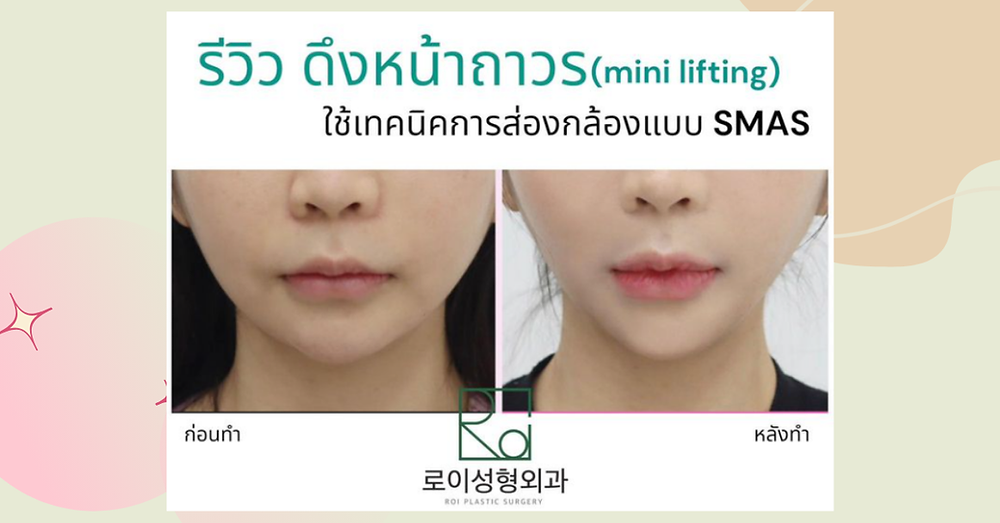 รีวิวมินิลิฟติ้ง
