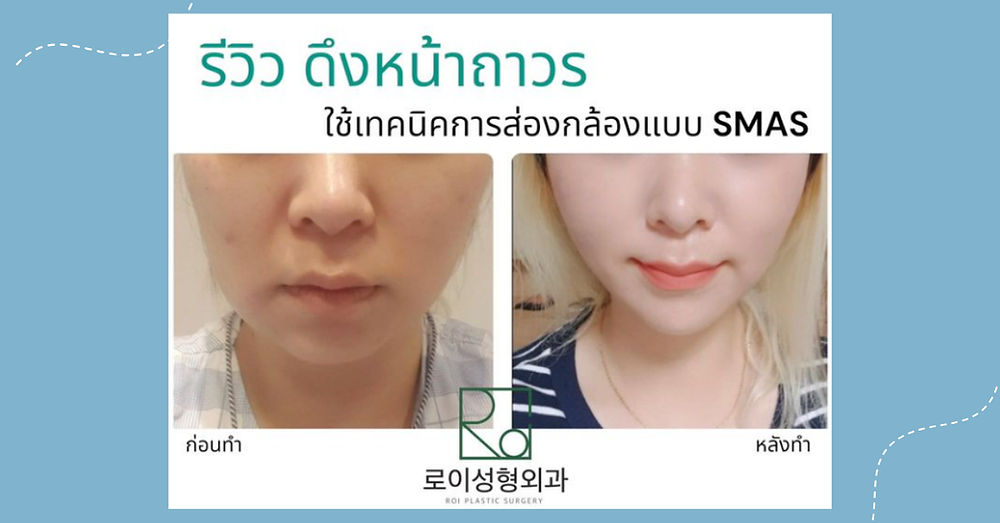 ดึงหน้าถาวร
