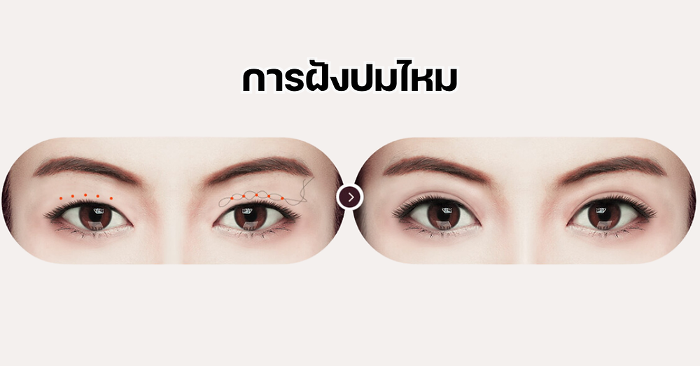 ตาไม่เท่ากัน ชั้นไขมันตาเยอะแก้ได้ที่โรงพยาบาลยูโน