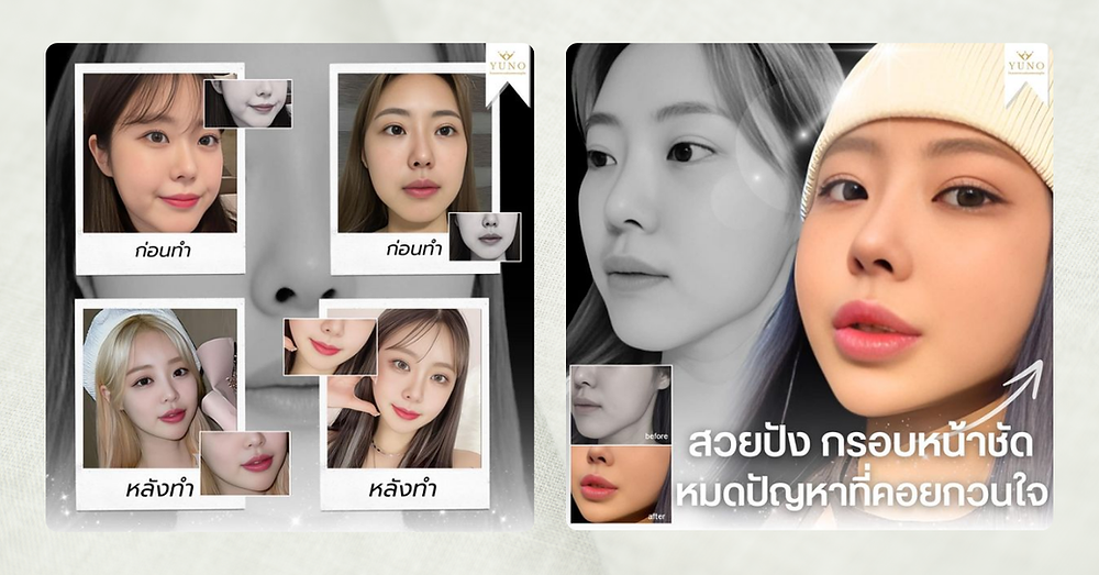 รีวิวศัลยกรรมโครงหน้า