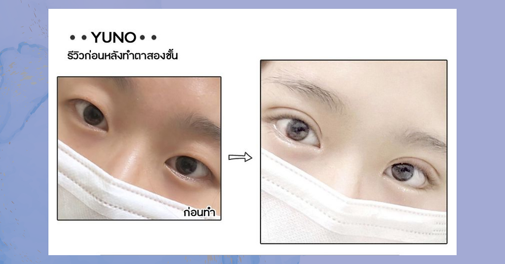 ศัลยกรรมตาหนังตาตก