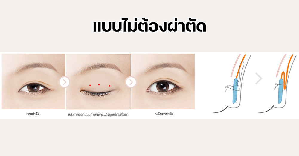 ตาไม่เท่ากัน ชั้นไขมันตาเยอะแก้ได้ที่โรงพยาบาลยูโน
