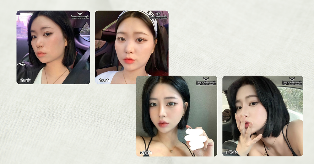 รีวิวศัลยกรรมโครงหน้า
