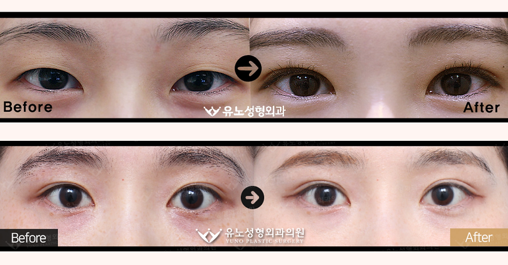 รีวิวศัลยกรรมกับโรงพยาบาลยูโน