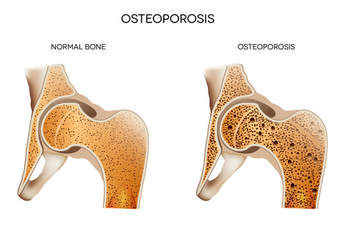 I have been diagnosed with Osteoporosis - what type of exercise should I be doing?