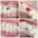 dental implant pune1