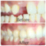 dental implant pune6