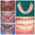dental implant pune2