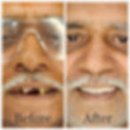 dental implant pune7