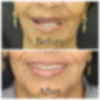 dental implant pune8