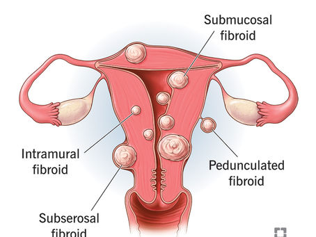 Understanding Uterine Fibroids