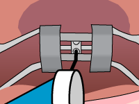 palatal-expander-step3.gif