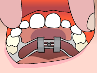 palatal-expander-step1.gif