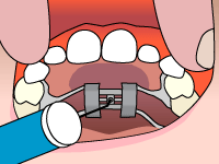 palatal-expander-step2.gif