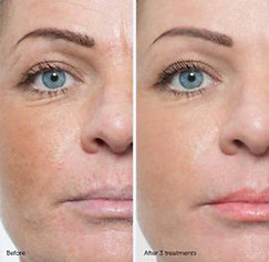 calgary, dermaplaning, pretty esthetics, facial treatments, eyebrows