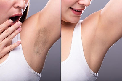 imgi_205_before-after-concept-underarm-hair-removal_1221914-8945.jpg