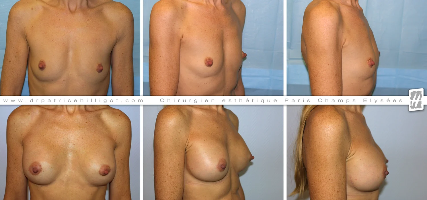 Chirurgie esthétique prothèses mammaires