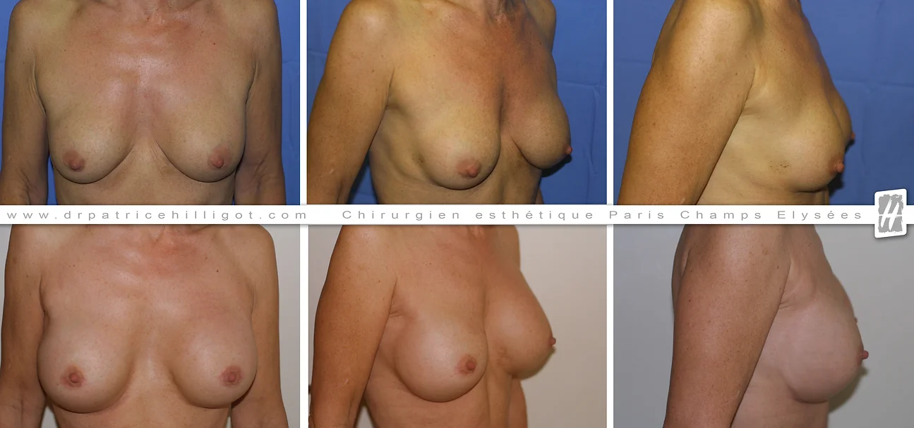 photos de resultat avant après de changement de prothèses mammaires par le DR Patrice Hilligot chirurgien esthetique à Paris