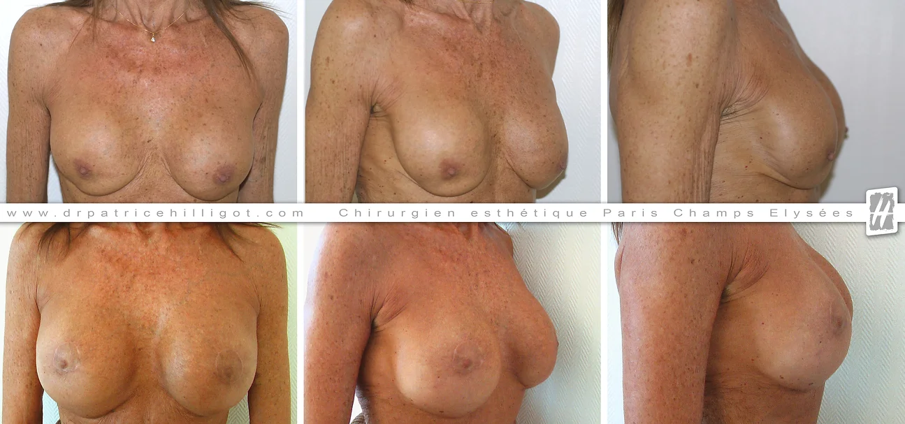 photos de resultat avant après de changement de prothèses mammaires par le DR Patrice Hilligot chirurgien esthetique à Paris