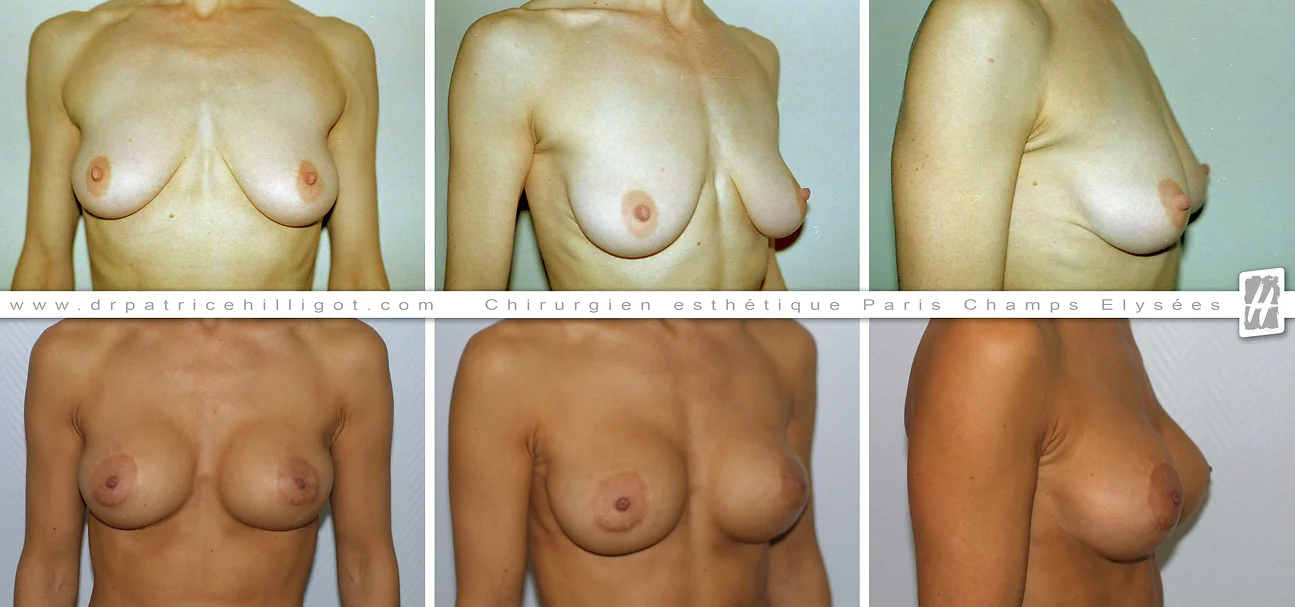 photos de resultat avant après de réhaussement mammaire par le DR Patrice Hilligot chirurgien esthetique à Paris