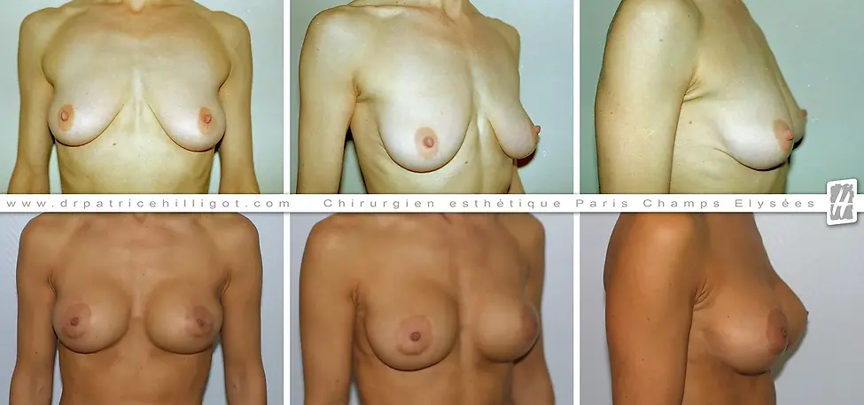 photos de resultat avant après de réhaussement mammaire par le DR Patrice Hilligot chirurgien esthetique à Paris