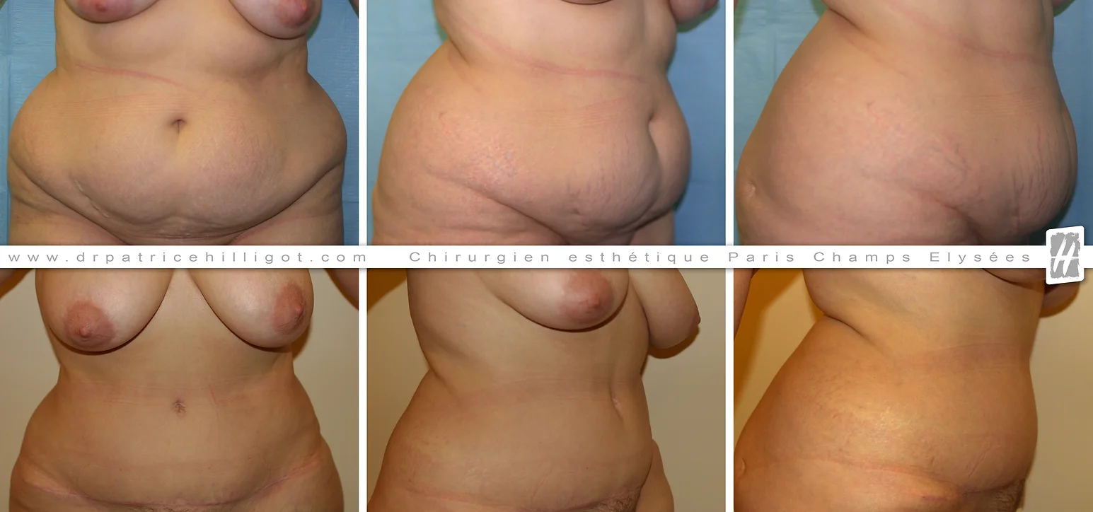 abdominoplastie femme