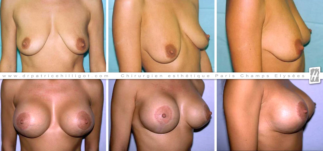 photos de resultat avant après de réhaussement mammaire par le DR Patrice Hilligot chirurgien esthetique à Paris