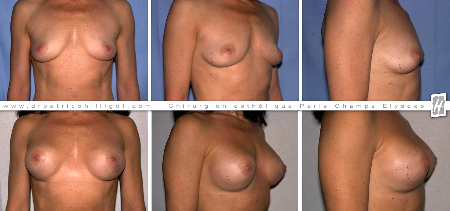 Chirurgie esthétique prothèses mammaires