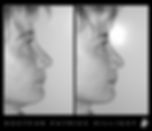 Rhinoplastie cas 12