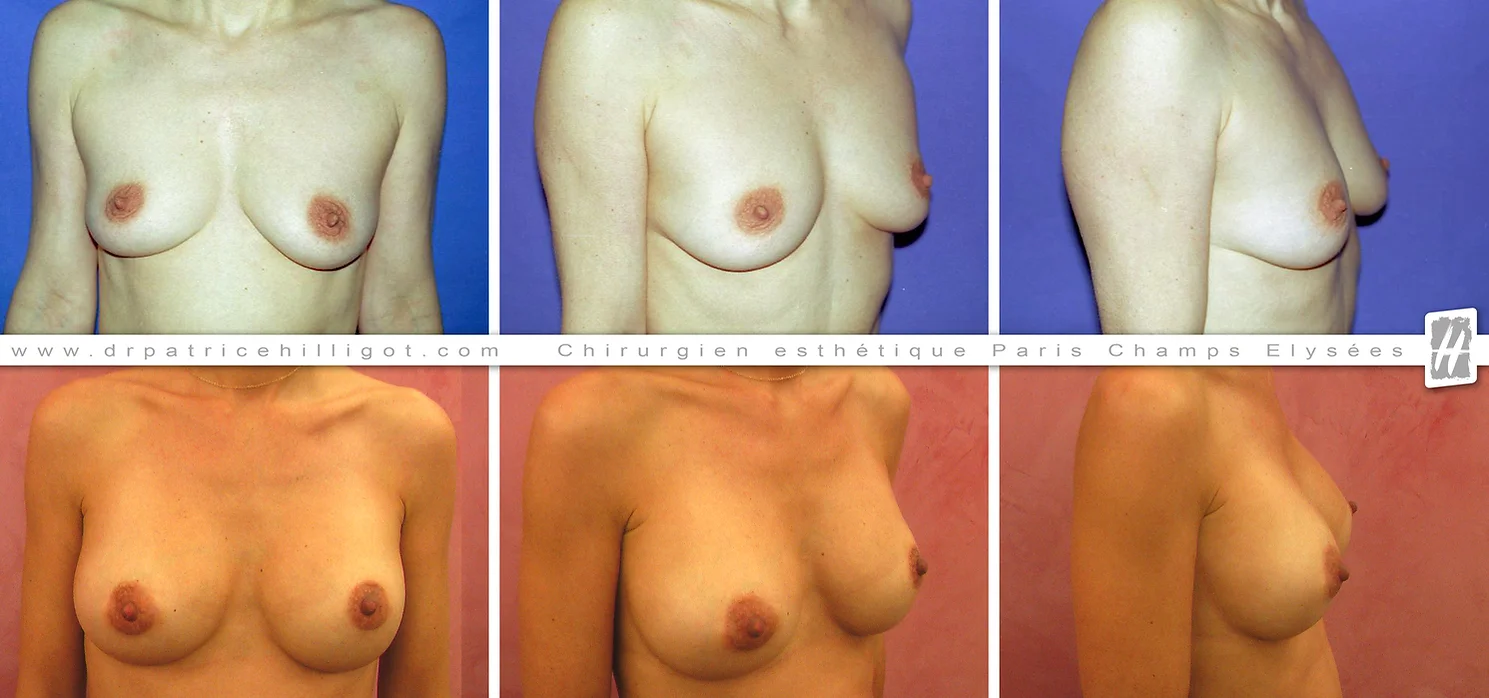Chirurgie esthétique prothèses mammaires