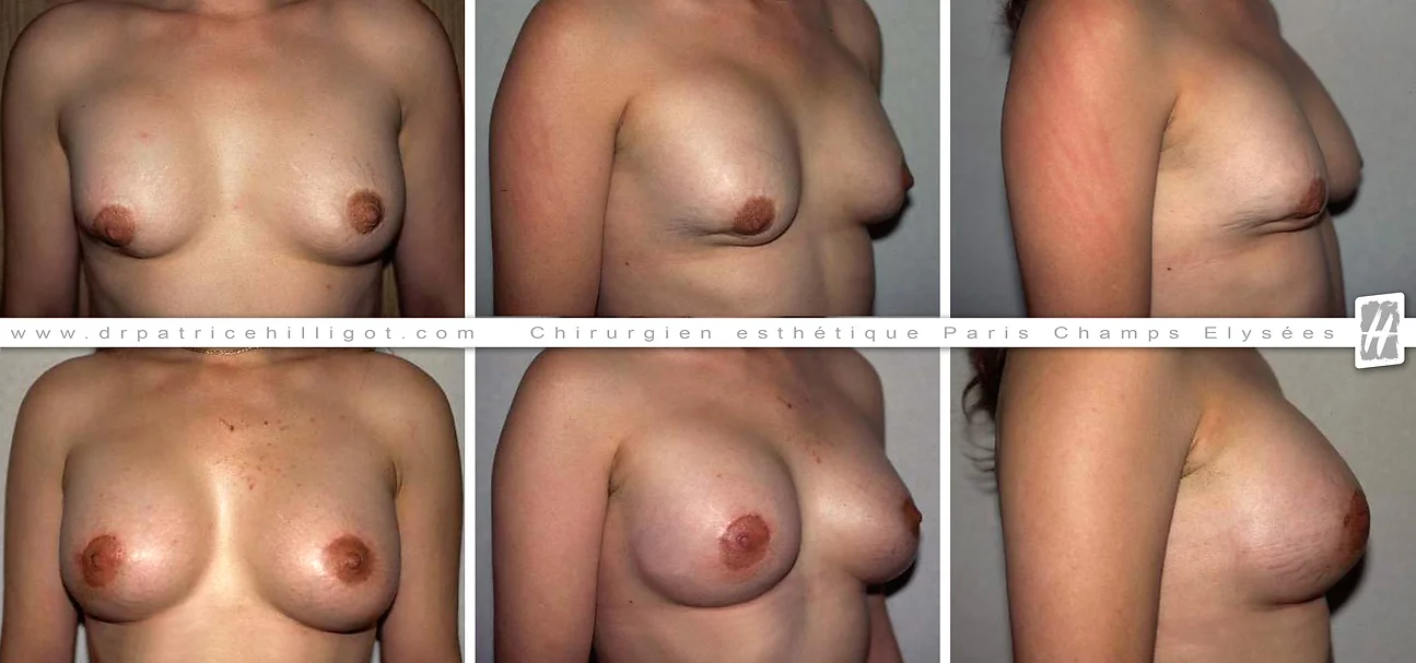 photos de resultat avant après de changement de prothèses mammaires par le DR Patrice Hilligot chirurgien esthetique à Paris