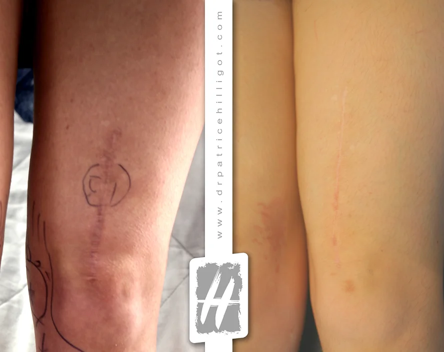 traitement cicatrice de la cuisse