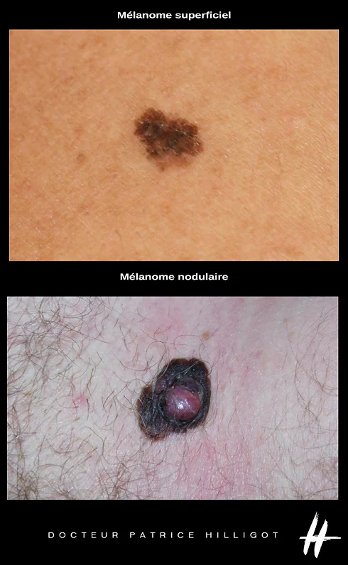 melanome-superficiel-nodumaire.webp