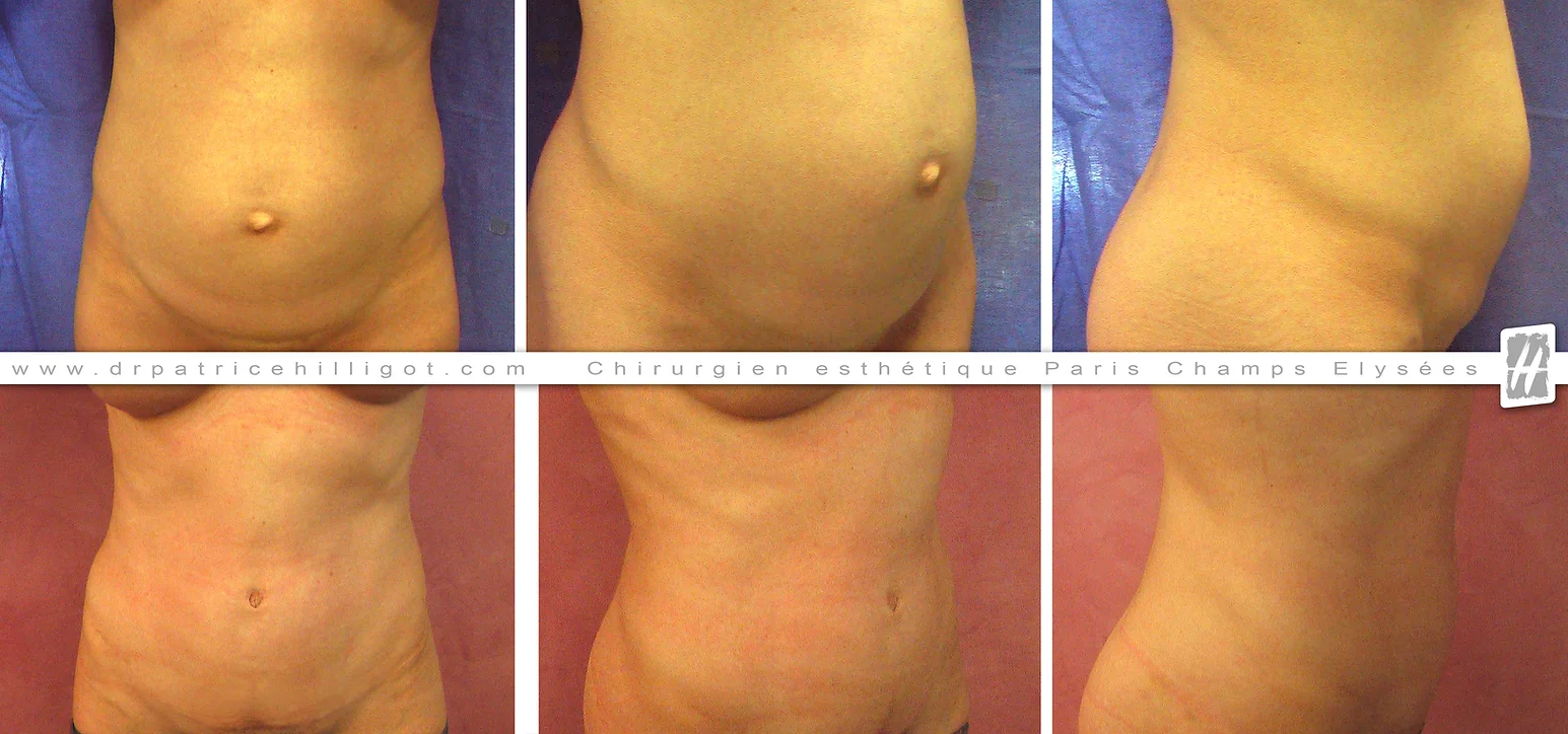 abdominoplastie femme