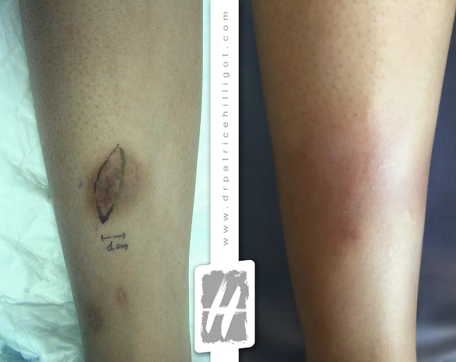 traitement cicatrice de la cuisse