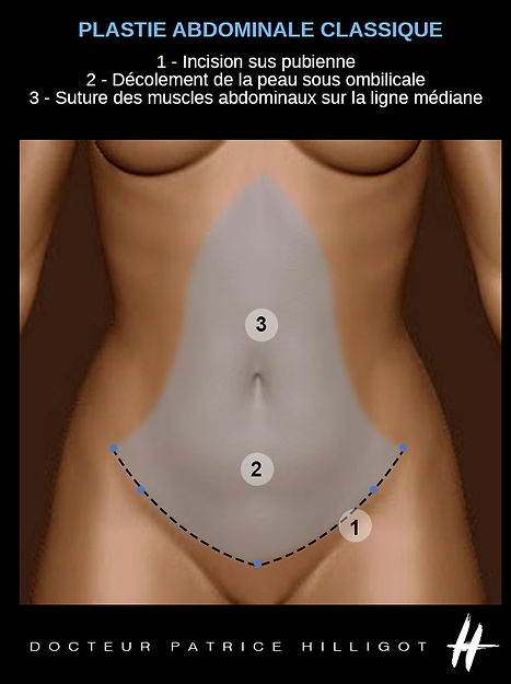 plastie abdominale classique