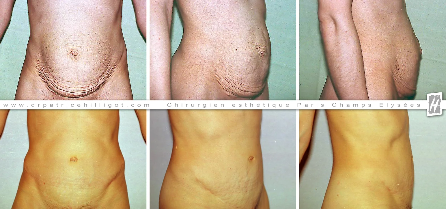 abdominoplastie femme
