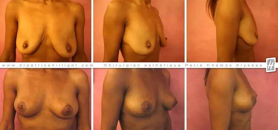 photos de resultat avant après de réhaussement mammaire par le DR Patrice Hilligot chirurgien esthetique à Paris
