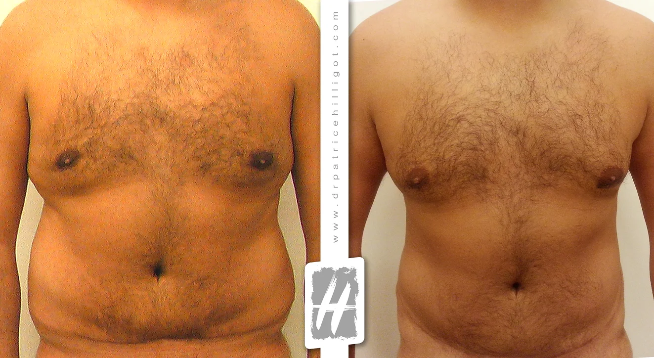 abdominoplastie homme