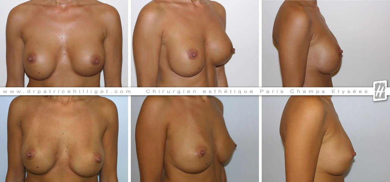photos de resultat avant après de changement de prothèses mammaires par le DR Patrice Hilligot chirurgien esthetique à Paris