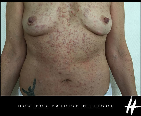 blog-tumeur-neurofibrome.jpg