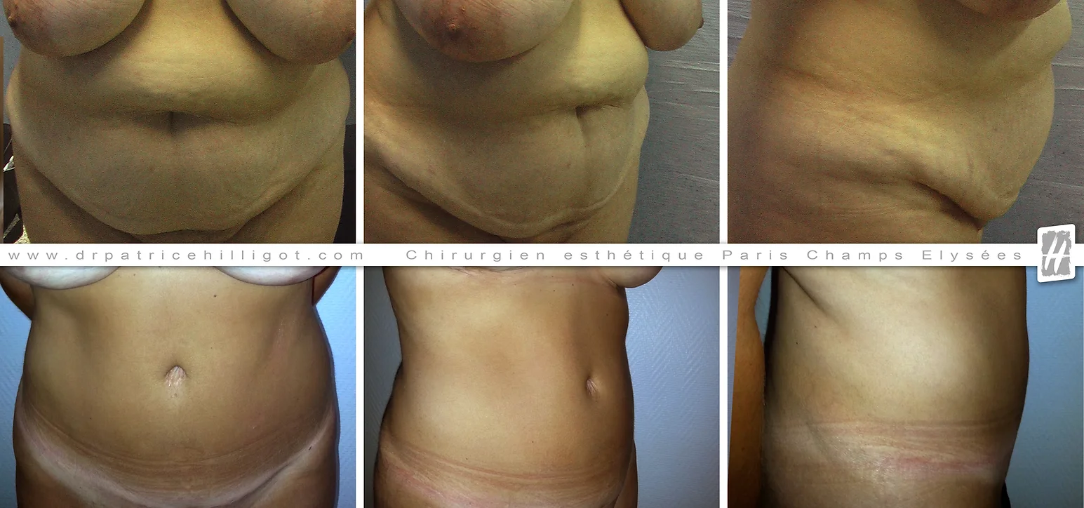 abdominoplastie femme
