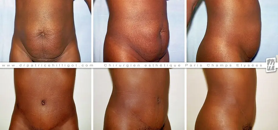 abdominoplastie femme